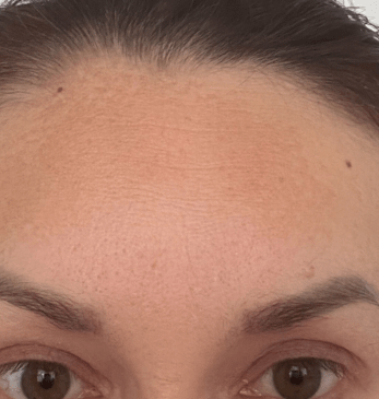 Glaciénne nachher – Melasma