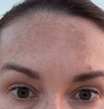 Glaciénne vorher – Melasma
