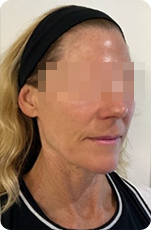RM Star nachher – Faltenbehandlung Ansicht links