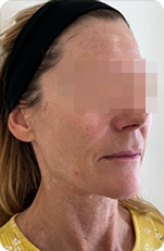 RM Star vorher – Faltenbehandlung Ansicht links