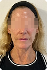 RM Star nachher – Faltenbehandlung frontal