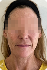 RM Star vorher – Faltenbehandlung frontal