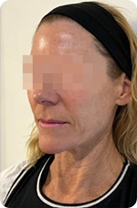 RM Star nachher – Faltenbehandlung Ansicht rechts