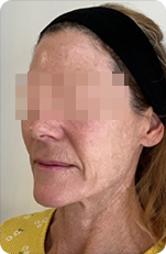 RM Star vorher – Faltenbehandlung Ansicht rechts