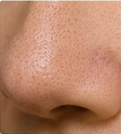 Verfeinerte Poren nach der AquaFacial Behandlung